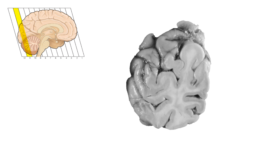 관상면(Coronal Section) - 뇌구조 | 뇌클러스터전문포털(K-Brain Net)